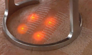 The exposure of the laser on the skin