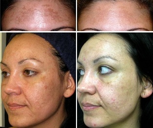 Before and after fractional non-ablative laser rejuvenation