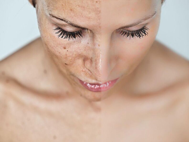 Front and after procedures