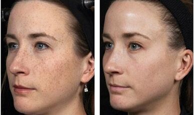 fractional facial rejuvenation before and after photos