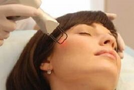 the essence of the procedure of fractional laser facial skin rejuvenation